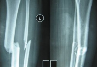 Phẫu thuật gãy xương cằng chân bằng đinh nội tủy có chốt ngang