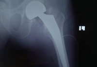 Thay khớp háng ở người bệnh 101 tuổi bị gãy cổ xương đùi